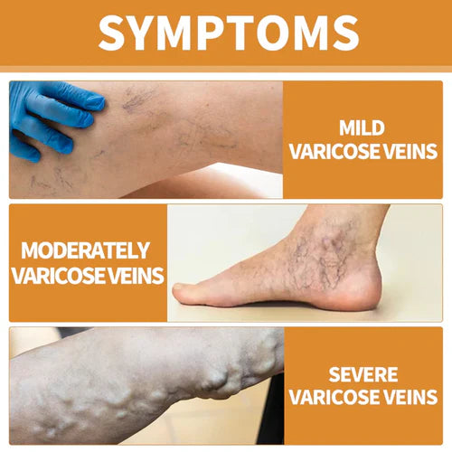 Bee Venom Vein Relief Spray